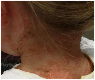 Linear Immunoglobulin a Bullous Dermatosis in Children